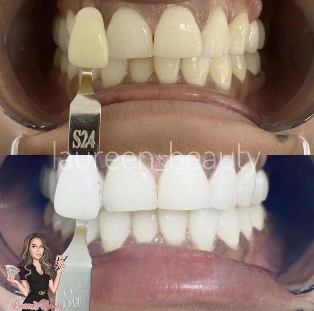 Laureen Beauty Blanchiment dentaire 91